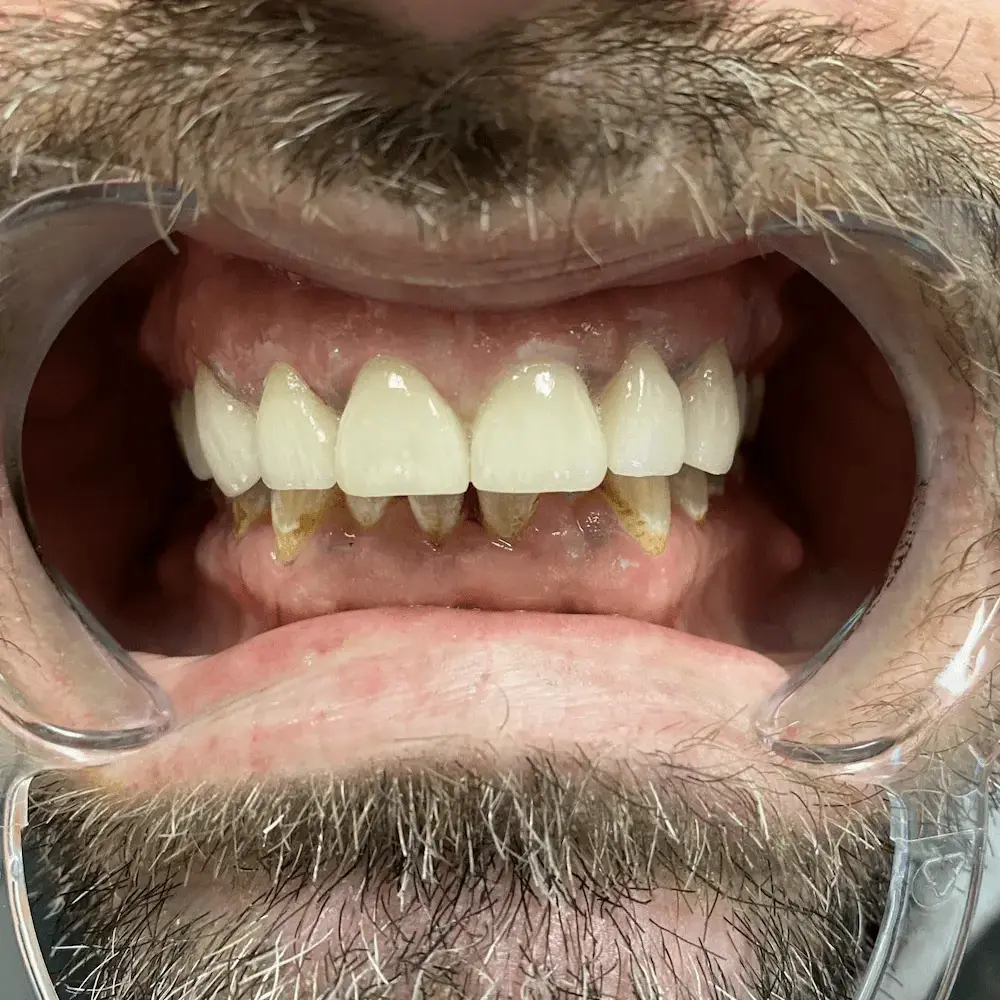 UpCare Patient 1 After