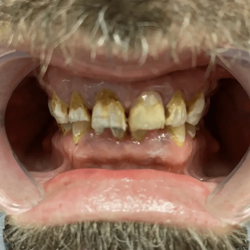 UpCare Patient 1 Before