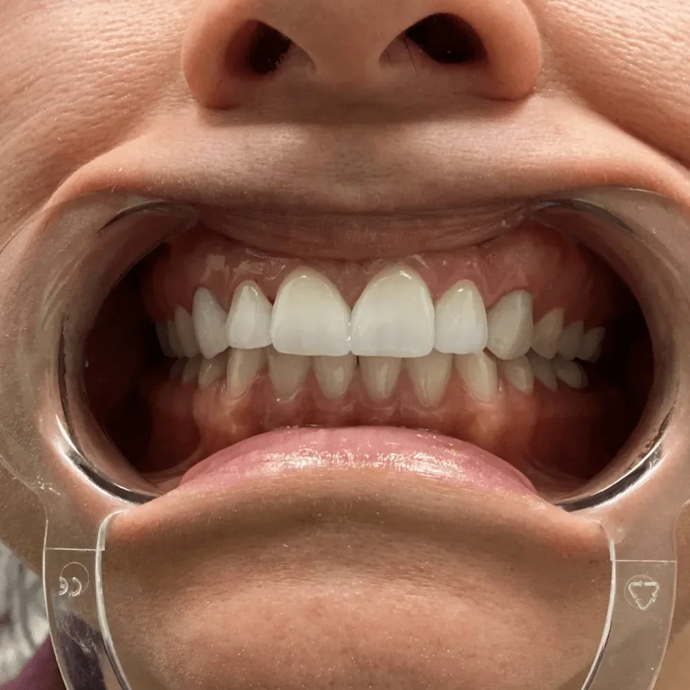 UpCare Patient 2 After