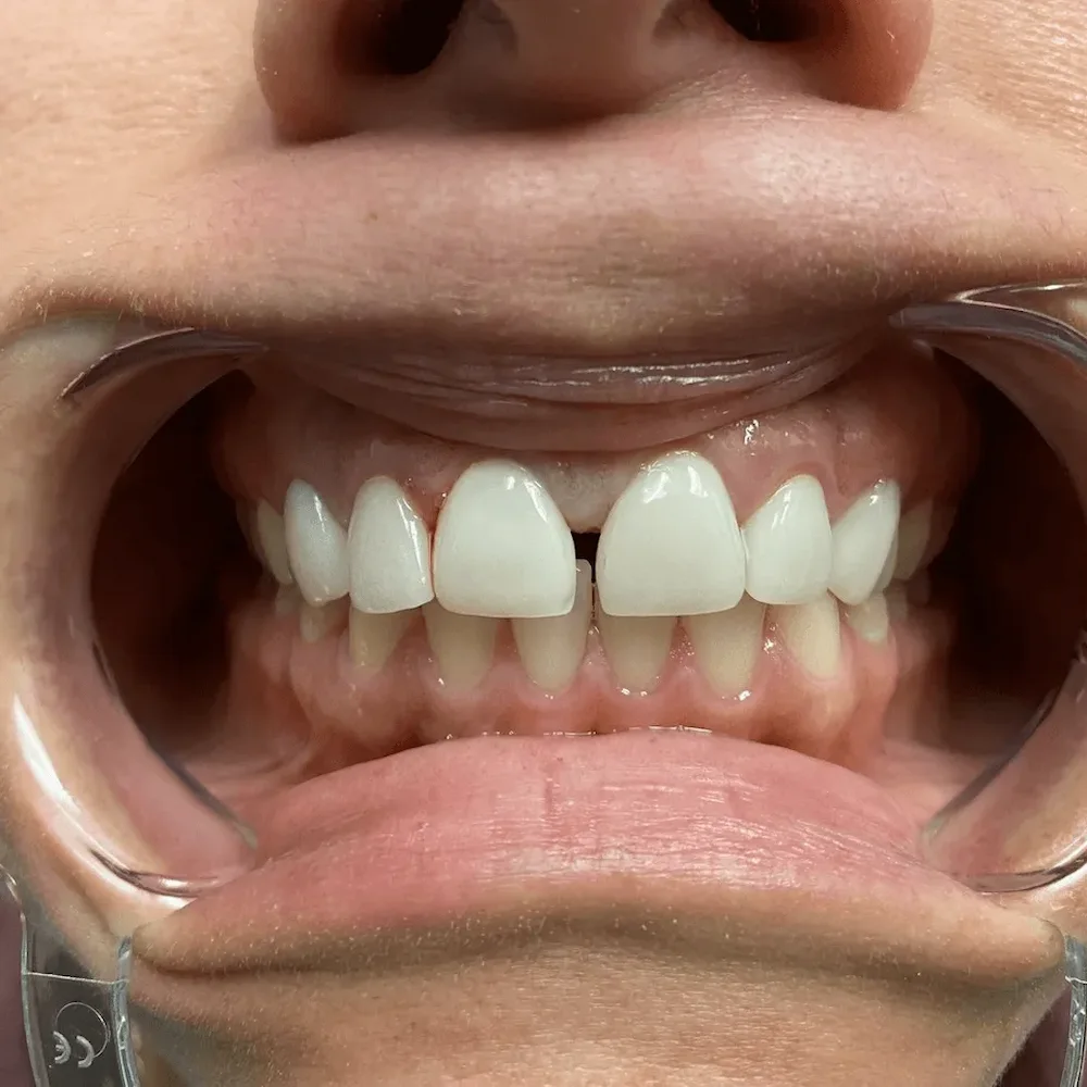 UpCare Patient 2 Before