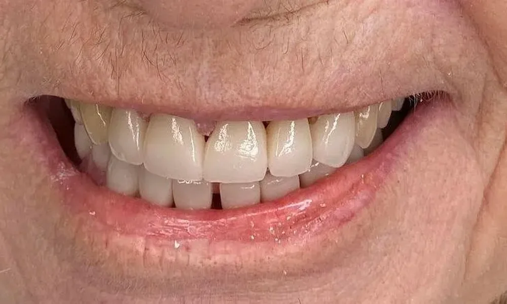 UpCare Patient 3 After