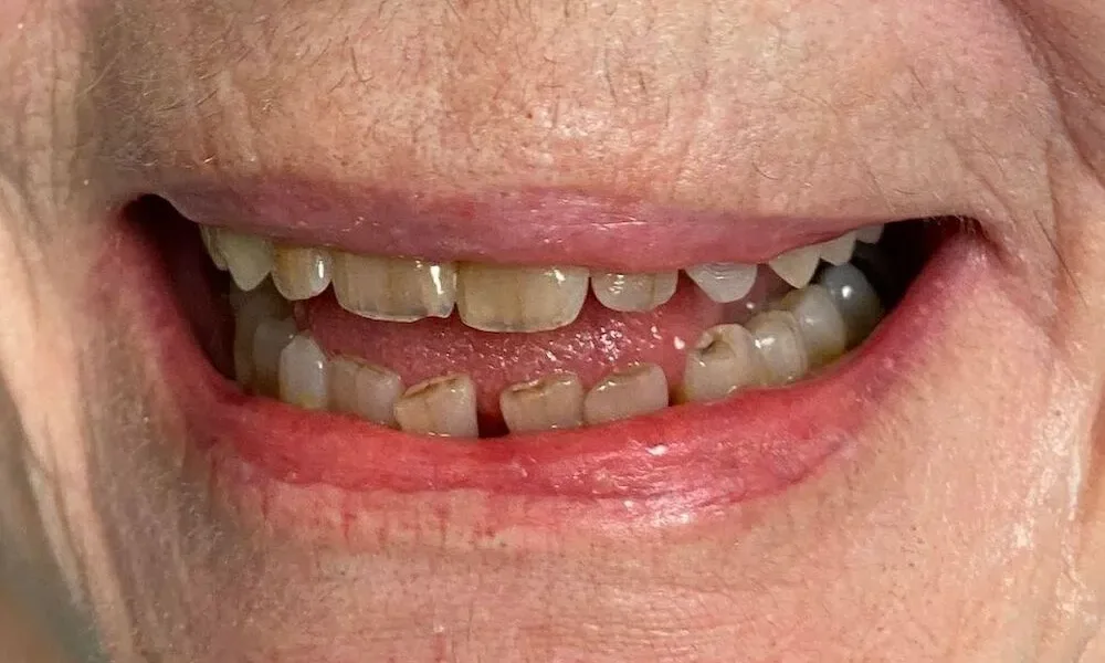 UpCare Patient 3 Before