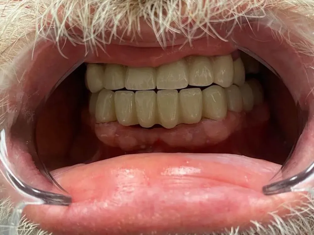 UpCare Patient 4 After