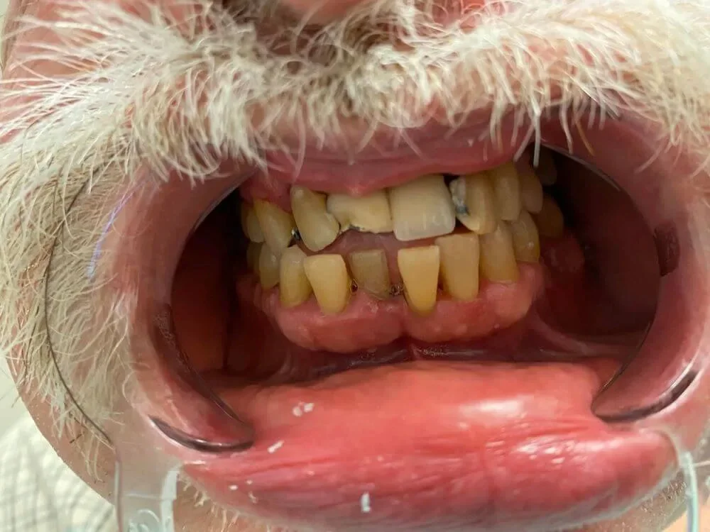 UpCare Patient 4 Before