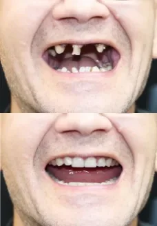 Implant Before After