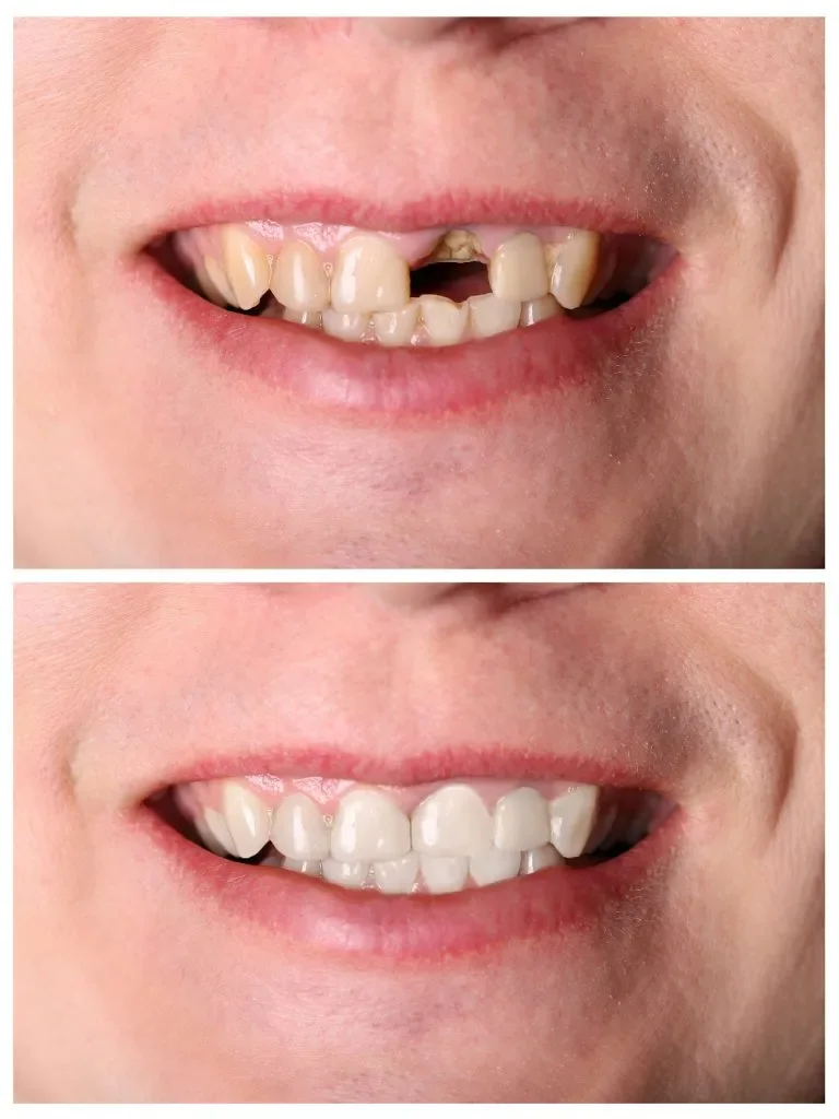 Single Implant Before After