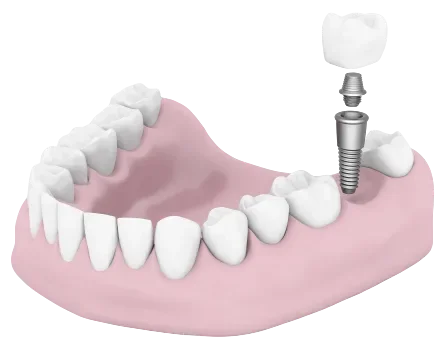 Single Implant Imge